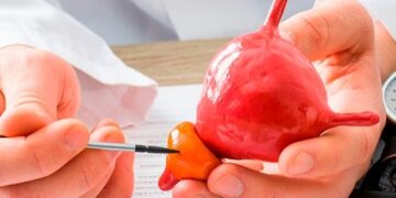 25% dos homens entre 40 a 49 anos podem ter o aumento benigno da próstata