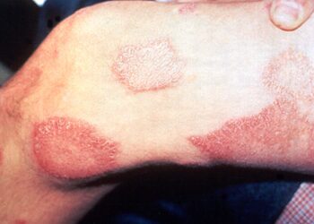 Pandemia de covid-19 faz notificações de hanseníase caírem 57% em 2021