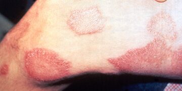 Pandemia de covid-19 faz notificações de hanseníase caírem 57% em 2021