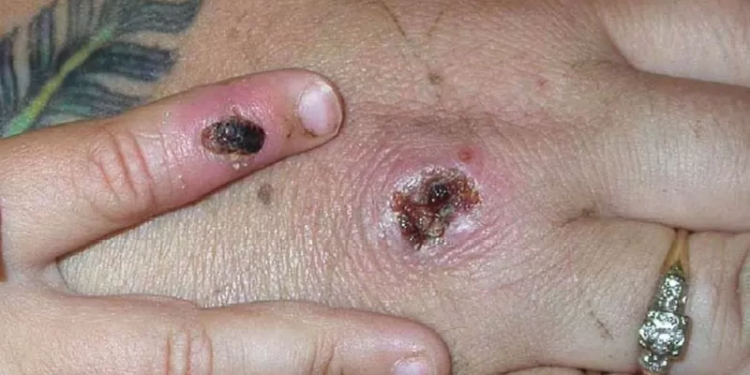 Anvisa sugere máscara e isolamento para adiar chegada de varíola no Brasil