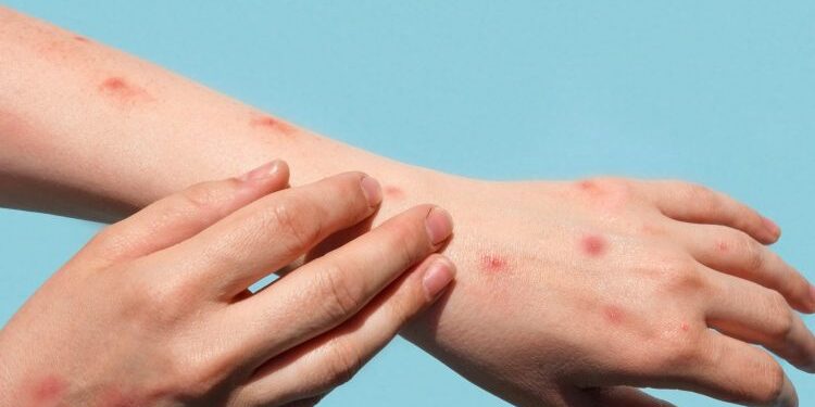 Primeiro caso de varíola do macaco é confirmado no Amazonas