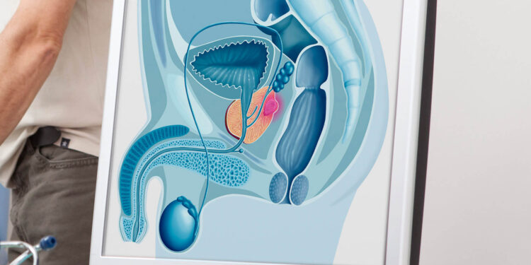 Aumento do câncer de próstata no AM é alerta para prevenção e fim do preconceito ao toque retal