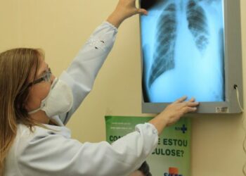 Dia de Combate à Tuberculose: especialista esclarece dúvidas sobre a doença