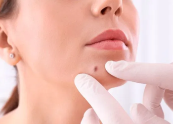 Dermatologista explica os tipos de câncer de pele