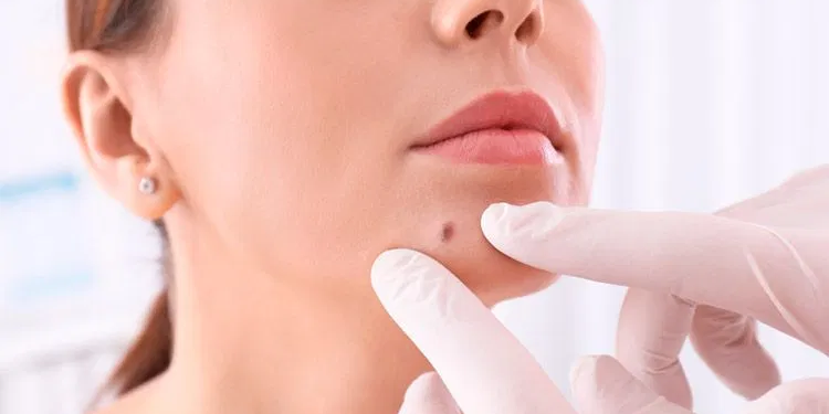 Dermatologista explica os tipos de câncer de pele