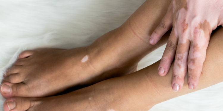 Vitiligo: SES-AM faz alerta para alto número de casos no estado 