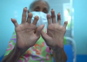 Pensão para filhos de vítimas da hanseníase é instituída em lei