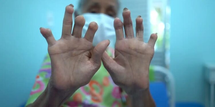 Pensão para filhos de vítimas da hanseníase é instituída em lei