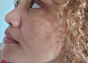 Melasma: cuidados essenciais para evitar o agravamento das manchas na pele