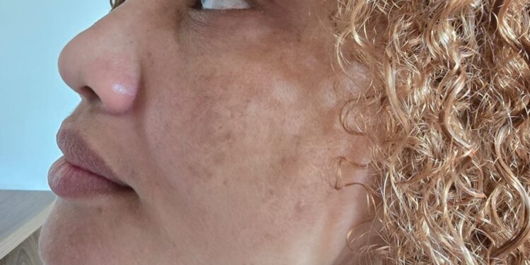 Melasma: cuidados essenciais para evitar o agravamento das manchas na pele