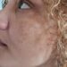 Melasma: cuidados essenciais para evitar o agravamento das manchas na pele