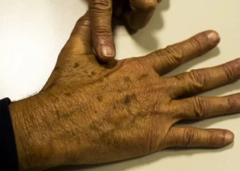 Campanha Dezembro Laranja alerta para os cuidados com o câncer de pele