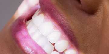 Procura por lentes de contato dentais cresce em consultórios; saiba se esse procedimento é adequado para você